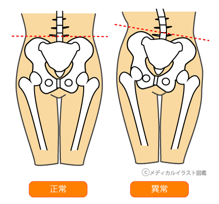 骨盤矯正